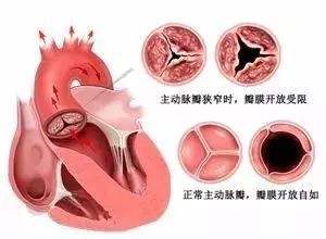 主動(dòng)脈口狹窄