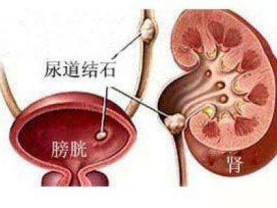 膀胱結(jié)石